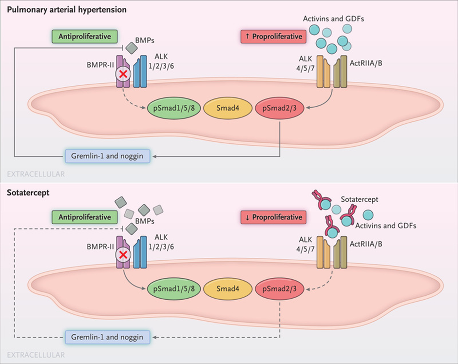 Mechanism of Action for Sotatercept in Pulmonary Arterial Hypertension