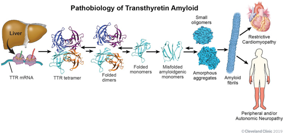 Pathobiology of Transthyretin Amyloid