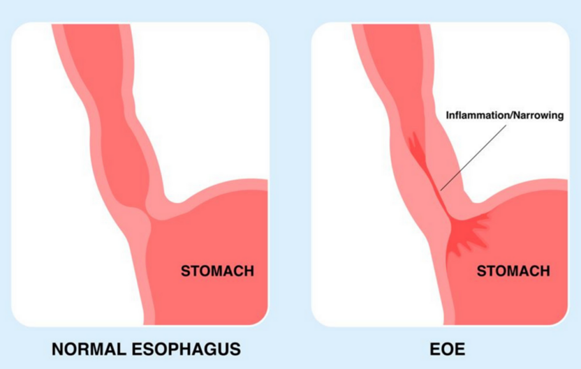 Normal vs EOE esophagus