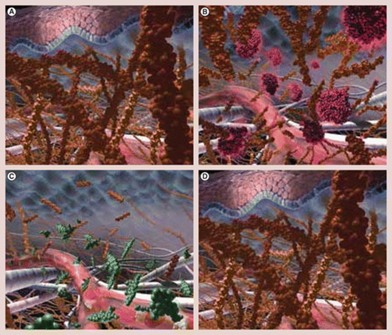 (A) The hyaluronan matrix (gold) creates resistance to bulk fluid. (B) Recombinant human hyaluronidase (purple) decreases local resistance to injection of other molecules, (C) allowing exposure of these molecules (green) to capillaries and lymphatics. (D) The hyaluronan barrier is rapidly reconstituted. Overview of recombinant human hyaluronidase-facilitated subcutaneous infusion of IgG in primary immunodeficiencies | Immunotherapy (futuremedicine.com)